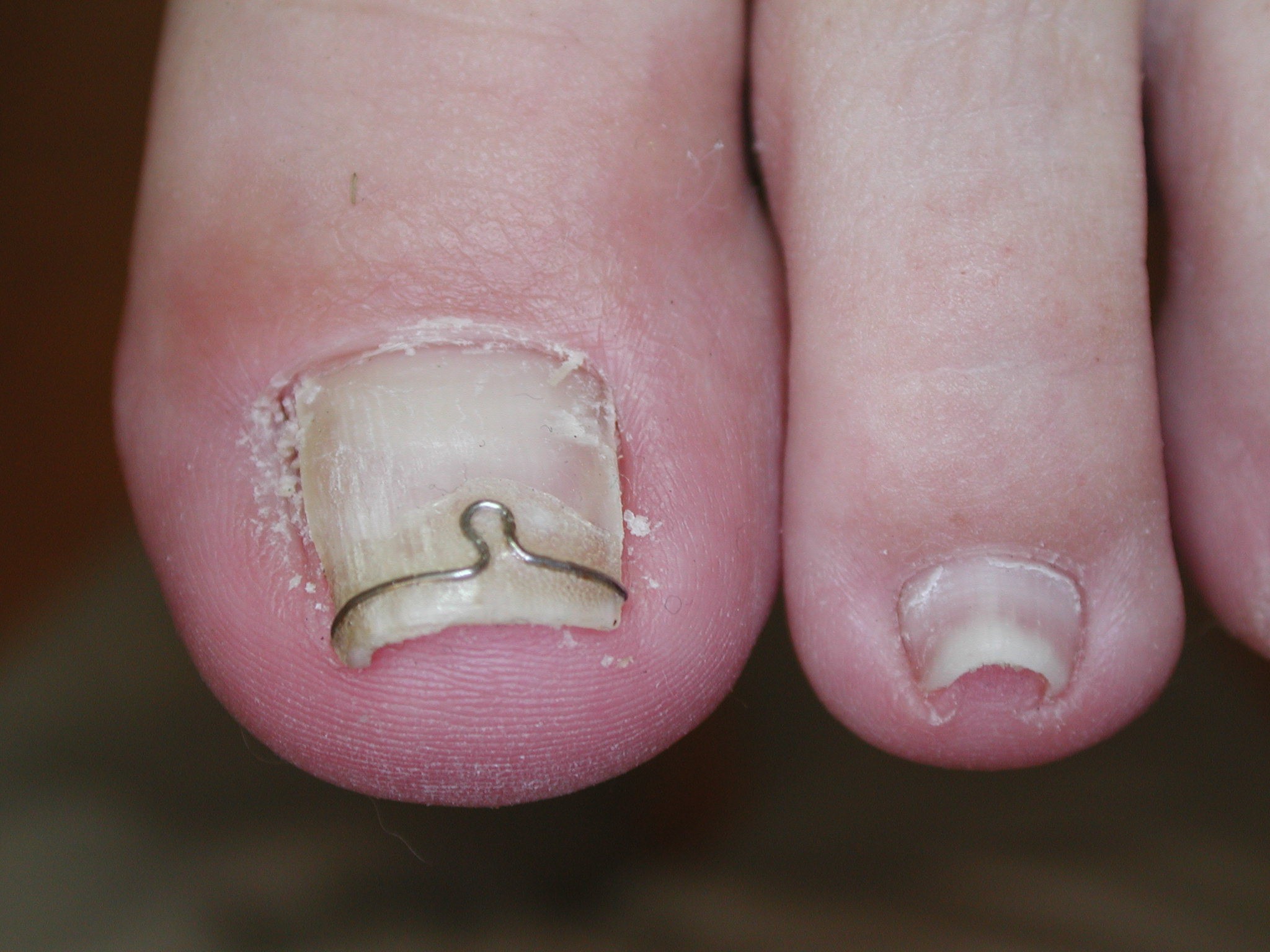 Ingrowing Toenail Correction With Surgery Bracing Foot Fix Clinic