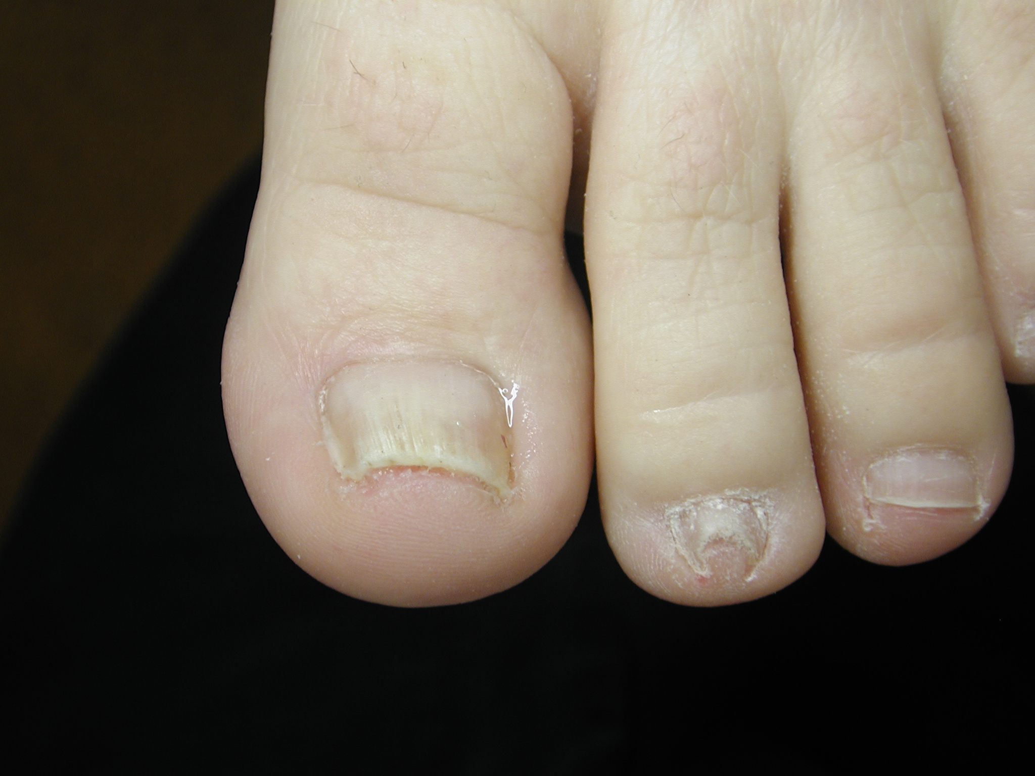 Ingrowing toenail correction with surgery & bracing | Foot Fix Clinic