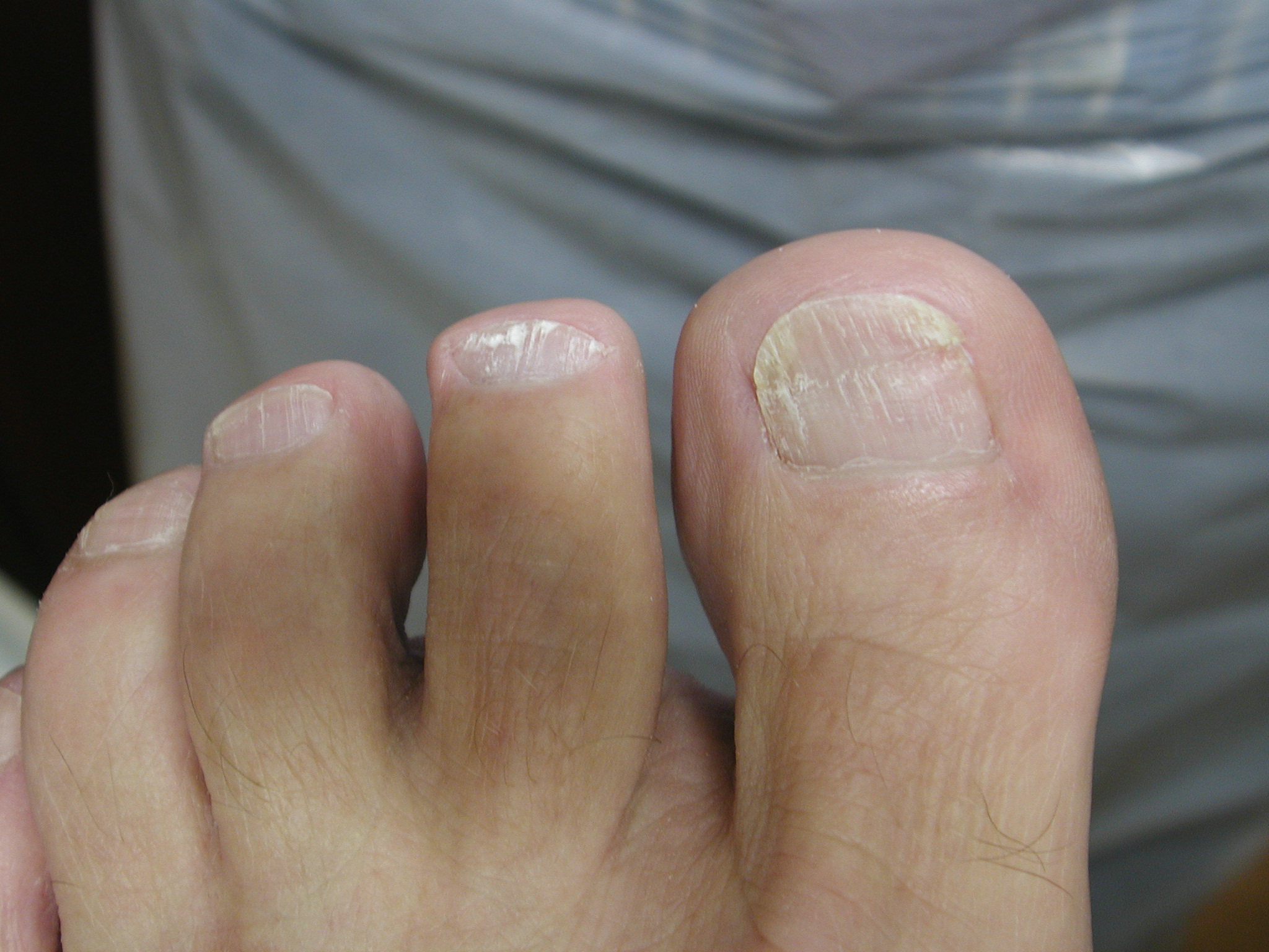 Should I be cutting toenails with a 'v' shape? - West Berkshire Foot Clinic