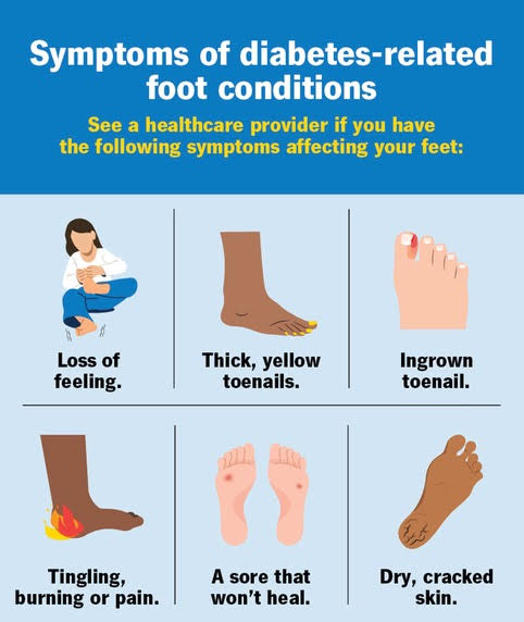 Symptoms of diabetes-related foot conditions